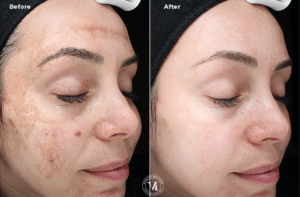 Got Sun Spots? Melasma?